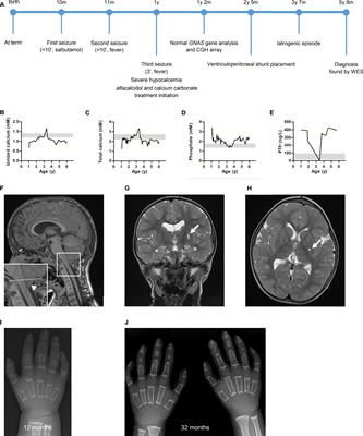 Case Report: Inactivating PTH/PTHrP Signaling Disorder Type 1 Presenting With PTH Resistance